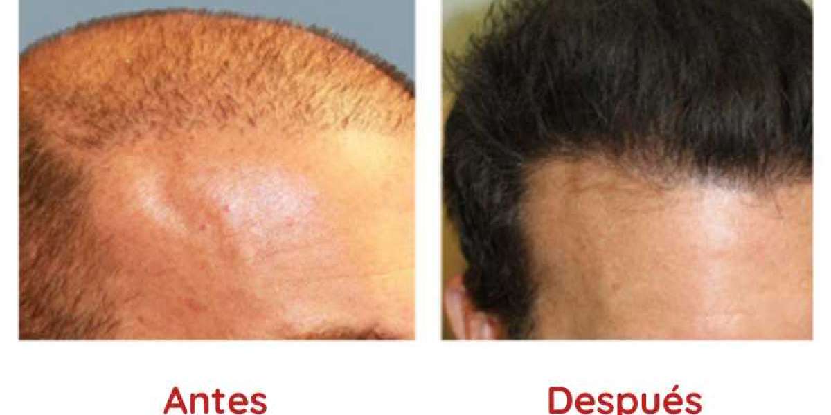 resultados del trasplante de cabello en hombres