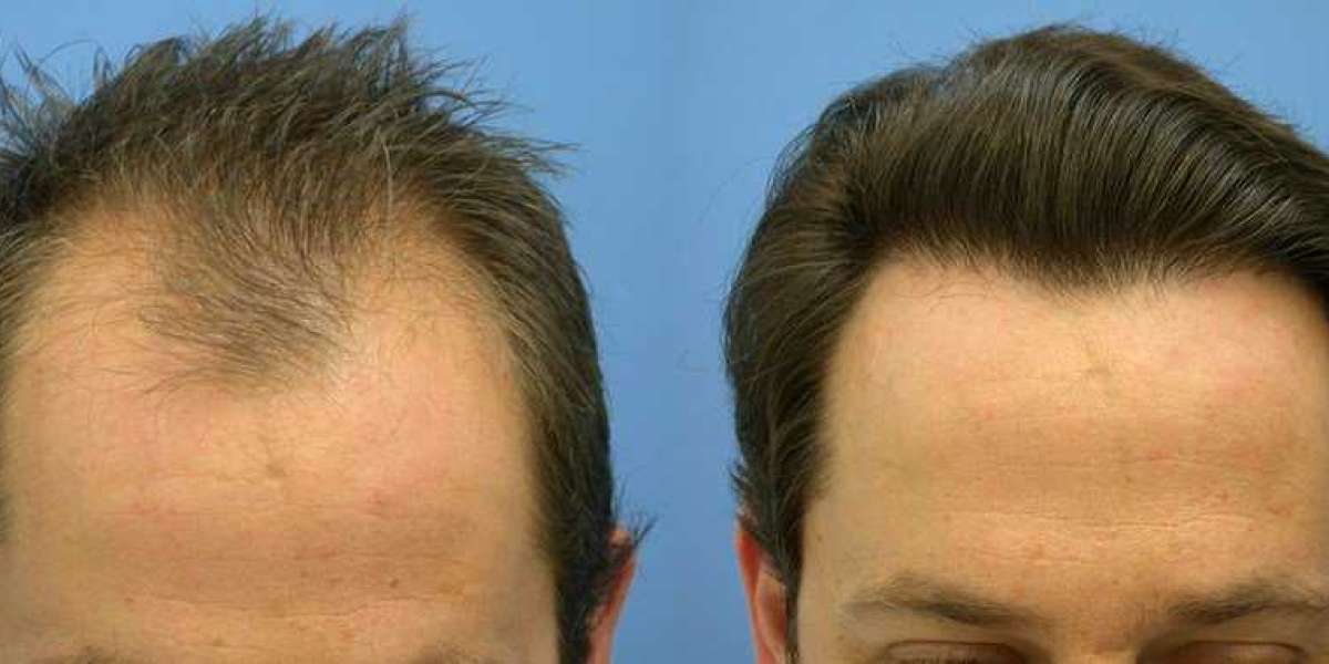 Hair Loss No More: Unveiling The Power Of Restoration Treatments