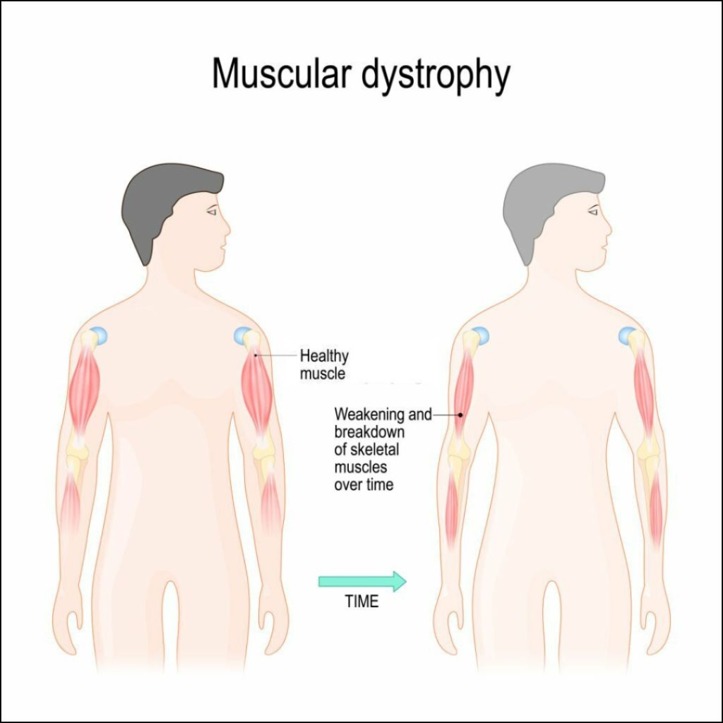 Stem Cell Muscular Dystrophy Treatment in India - MedTravellers